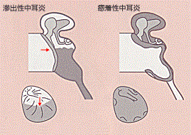 癒着性中耳炎