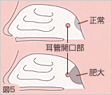 子どものアデノイド肥大の手術