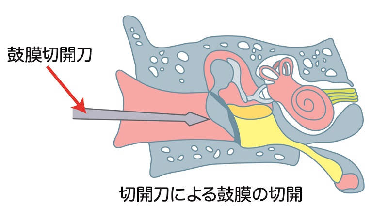 大阪の老木医院による急性中耳炎の手術(鼓膜切開術)