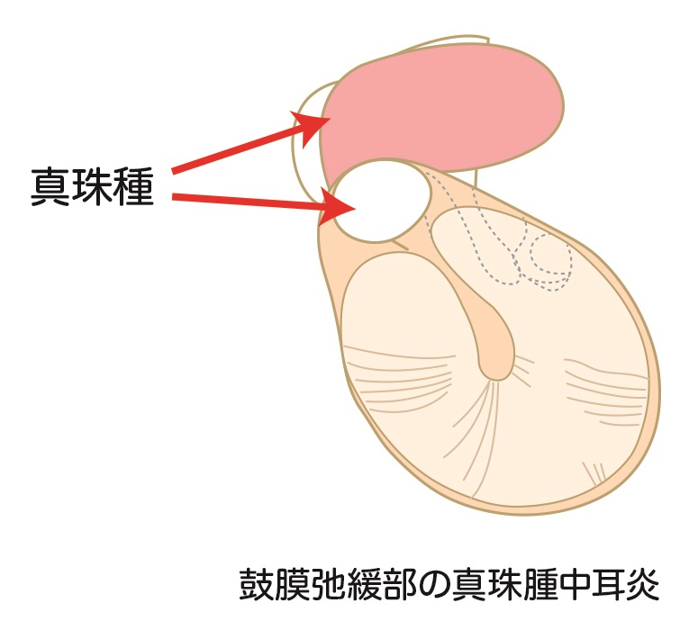 腫 真珠