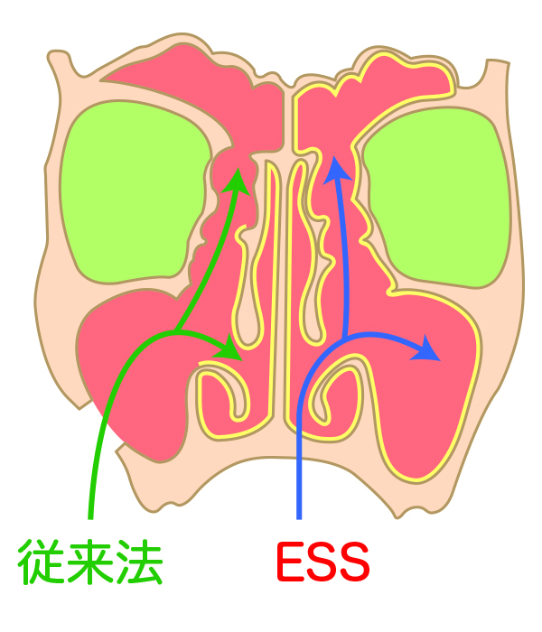 ESS（内視鏡下・副鼻腔手術）