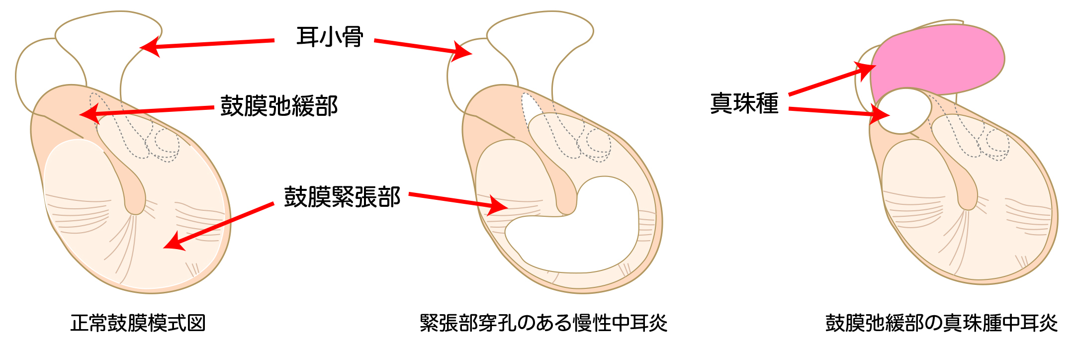 慢性中耳炎