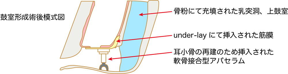 大阪の老木医院による鼓室形成術後模式図