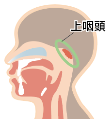 慢性上咽頭炎とは