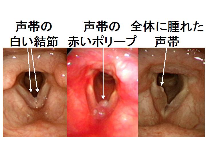 ポリープ 後 声帯 手術