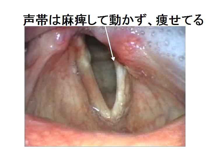 声帯麻痺(反回神経麻痺)