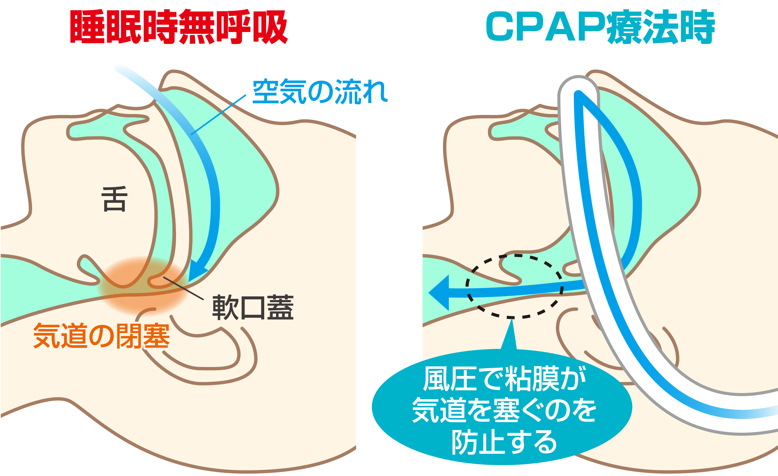 CPAP治療なら大阪・和泉市の老木医院