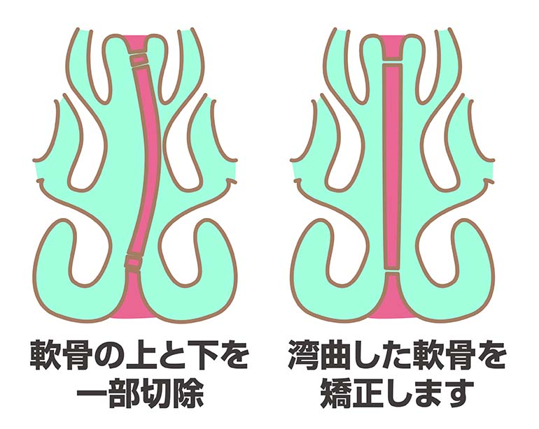大阪で鼻中隔湾曲症の手術なら老木医院｜年間259件の手術実績