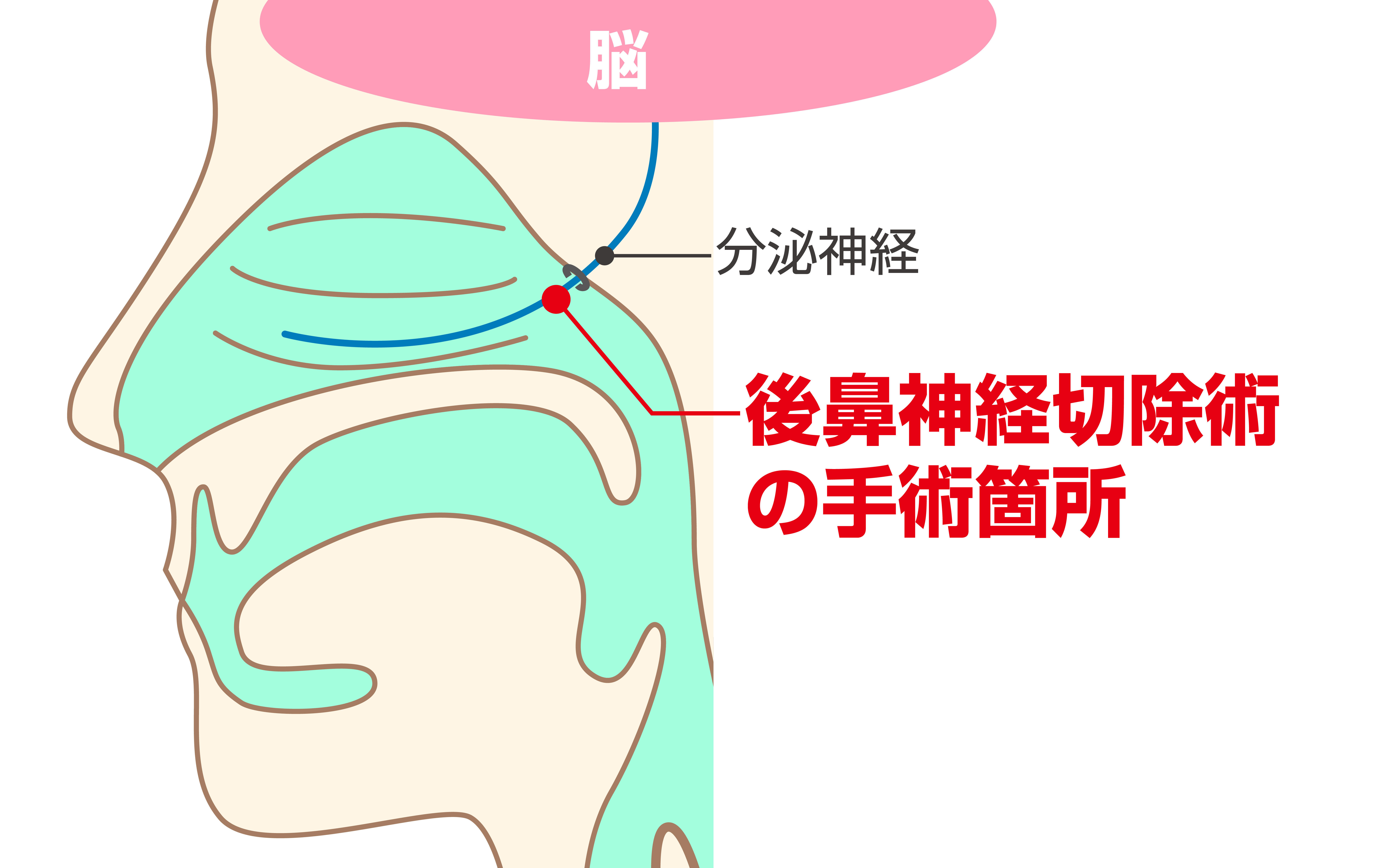 大阪でアレルギー性鼻炎 花粉症の手術なら老木医院へ