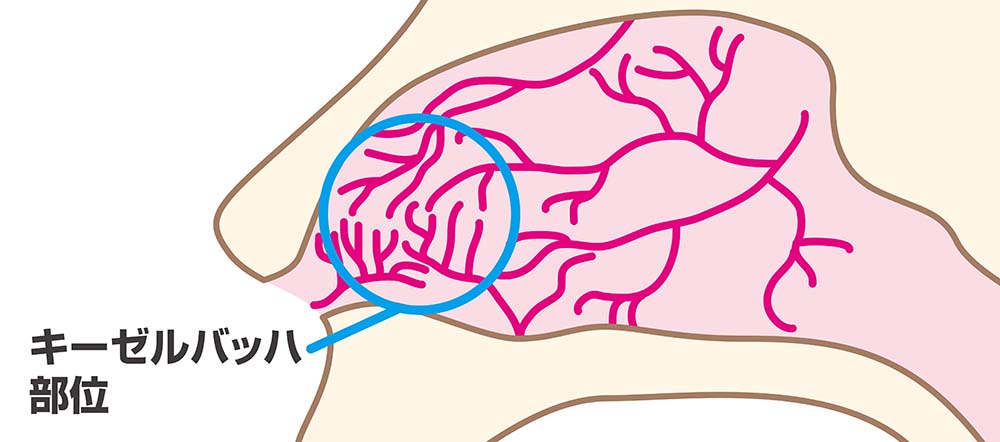 鼻血 が よく 出る