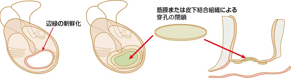 大阪の老木医院による鼓膜形成術