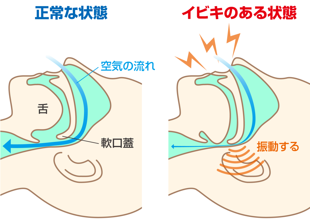 いびき 鼻 の 奥 が 鳴る