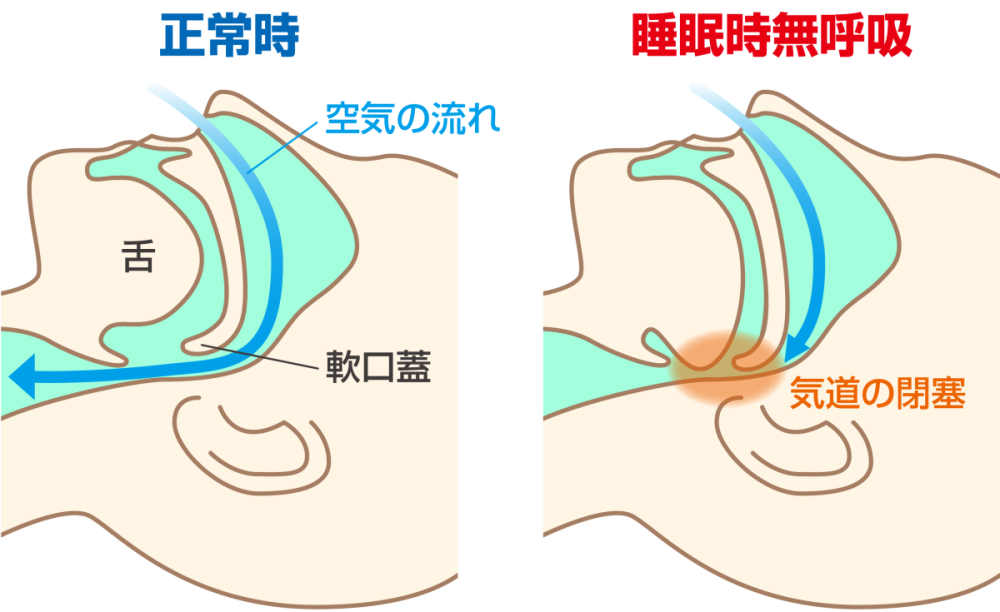 睡眠時無呼吸症候群のメカニズム