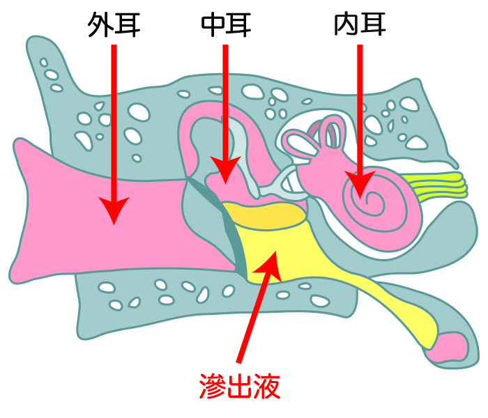 滲出性中耳炎